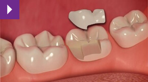 Inlays & Onlays