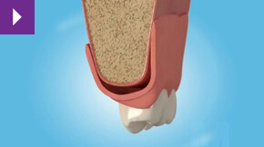 Denture Stabilisation