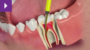 root canal treatment